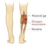 Illustrazione anatomica del polpaccio con strappo muscolare cicatrizzato male nei muscoli gemelli.