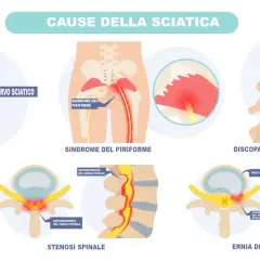 Illustrazione delle cause della sciatica: nervo sciatico, sindrome del piriforme, discopatia degenerativa, stenosi spinale ed ernia del disco. Addio al dolore del nervo sciatico.