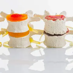 Modello di colonna vertebrale con vertebre che si toccano, mostrando dischi intervertebrali colorati.