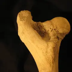 Frammento osseo con segni di necrosi testa femore. La terapia farmacologica è fondamentale per contrastare questa condizione.