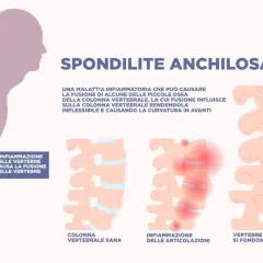 Illustrazione della spondilite anchilosante: infiammazione vertebrale che causa fusione, rigidità e curvatura. La durata vita non è influenzata significativamente.