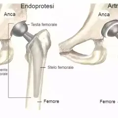 Illustrazione comparativa di protesi d'anca: endoprotesi e artroprotesi. La protesi totale d'anca sostituisce l'articolazione danneggiata.