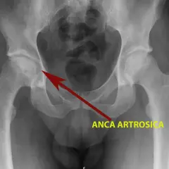 Radiografia del bacino che mostra un'anca artrosica, con freccia rossa che indica l'area interessata, suggerendo possibili coxalgia sintomi.