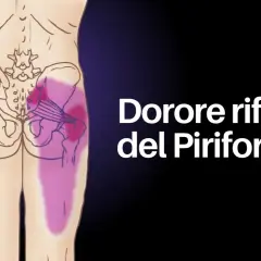 Dolore riferito del piriforme: illustrazione anatomica che mostra l'area di dolore irradiato lungo la gamba, tipico della sindrome del piriforme.