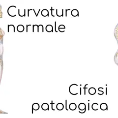 Confronto tra colonna vertebrale con curvatura normale e cifosi patologica. Si guarisce dalla cifosi?