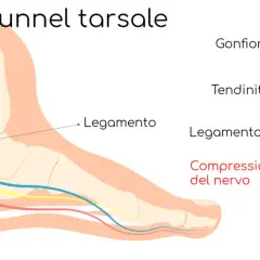 Illustrazione anatomica del tunnel tarsale: nervo tibiale posteriore compresso, gonfiore e tendinite.