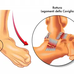 Illustrazione di una caviglia con un cerchio che evidenzia la zona interessata da una rottura dei legamenti, mostrando la sindesmosi caviglia.