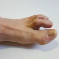 Dita del piede che si contraggono, con calli evidenti e unghie ispessite.