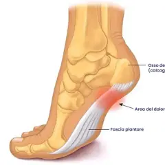 Illustrazione anatomica del piede che mostra l'osso del tallone e la fascia plantare. L'area rossa indica il dolore, spiegando perché viene la tallonite.