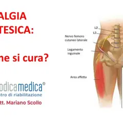 Meralgia parestesica: illustrazione del nervo femorale compresso, con sintomi e area affetta.