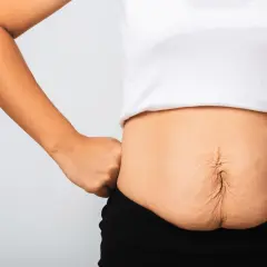 Addome con smagliature e diastasi addominale: cosa fare per recuperare tonicità e benessere.