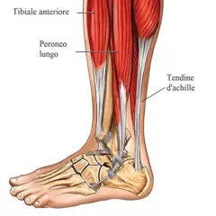 Dettaglio anatomico della gamba e del piede, con evidenziato l'ispessimento del tendine d'Achille.
