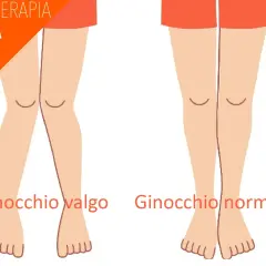 Confronto ginocchio valgo e ginocchio normale, utile per il valgus stress test.
