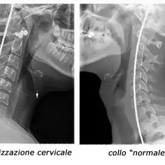 Radiografie del collo: a sinistra, rettilineizzazione cervicale con riduzione della lordosi; a destra, collo "normale".