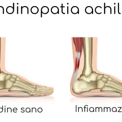 Confronto anatomico: tendine d'Achille sano e infiammato, causa di bruciore ai talloni a riposo.