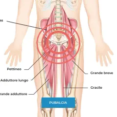 Illustrazione anatomica che mostra i muscoli adduttori e il psoas, aree spesso coinvolte nella pubalgia. Scopri i rimedi.