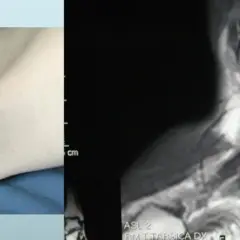 Immagine divisa: a sinistra, un piede con freccia rossa che indica un gonfiore; a destra, una risonanza magnetica che mostra il muscolo peroneo lungo.