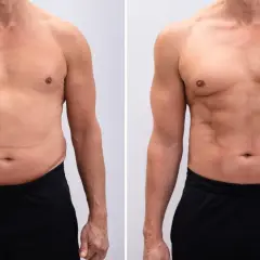 Uomo prima e dopo il trattamento per la diastasi addominale. La pinna addominale è visibilmente ridotta.