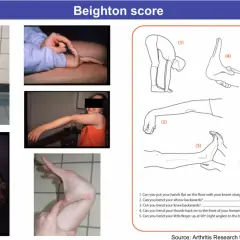 Valutazione dell'iperlassità articolare con il Beighton score. Immagini mostrano flessibilità di gambe, dita e schiena.
