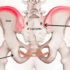 Anatomia del bacino con evidenziata la cresta iliaca. Il dolore alla cresta iliaca può avere vari sintomi.