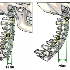 Confronto tra colonna cervicale normale (1.5 cm) e iperlordosi cervicale (>4 cm).