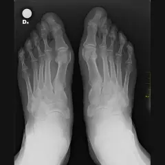 Radiografia dei piedi che mostra un marcato alluce valgo angolo, con deviazione dell'alluce verso le altre dita.