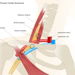 Illustrazione anatomica che mostra le strutture coinvolte nella sindrome dello stretto toracico. Evidenzia la compressione del plesso brachiale e dei vasi sanguigni.