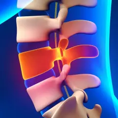 Vertebre lombari con disco intervertebrale infiammato, evidenziando le potenziali iperlordosi lombare conseguenze.