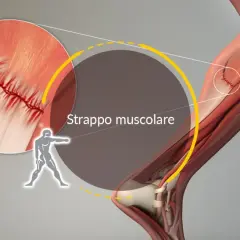 Dettaglio di uno strappo muscolare con suture. L'immagine illustra la lesione e i tempi di recupero.