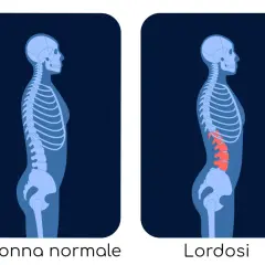 Confronto tra colonna vertebrale normale e lordosi. La lordosi cura è un percorso per correggere l'eccessiva curvatura lombare.