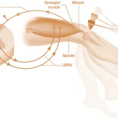 Schema del riflesso patellare: martelletto colpisce ginocchio, innescando un segnale nervoso che, passando per il midollo spinale, causa contrazione muscolare e movimento della gamba, evidenziando l'ipertono muscolare.