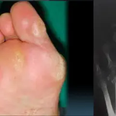 Piede con callosità e radiografia delle ossa metatarsali, possibili cause di metatarsalgia.