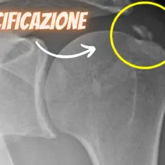 Radiografia spalla: calcificazioni evidenziate in giallo, indicative di tendinopatia calcifica.