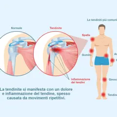Illustrazione che mostra la differenza tra un tendine normale e uno infiammato, evidenziando le zone più colpite dalla tendinite e come si cura.