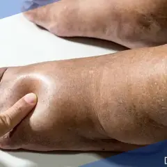 Piede gonfio con evidente imbibizione edematosa, segno di accumulo di liquidi.