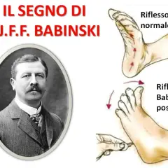 Ritratto di J.J.F. Babinski accanto a illustrazioni del riflesso normale e del riflesso Babinski positivo.