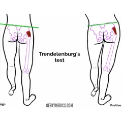 Illustrazione del test di Trendelenburg: bacino livellato (negativo) vs. bacino inclinato (positivo), evidenziando la debolezza del gluteo medio.