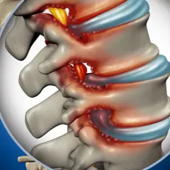 Dettaglio anatomico della colonna vertebrale lombare con infiammazione e compressione nervosa. Si può guarire da una stenosi lombare con le giuste cure.