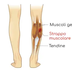 Illustrazione anatomica del polpaccio con strappo muscolare cicatrizzato male nei muscoli gemelli.