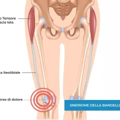 Illustrazione anatomica del ginocchio che mostra la bandelletta ileotibiale e l'area di dolore, indicando la sindrome della bandelletta ileotibiale che non guarisce.