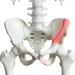 Scheletro del bacino con evidenziata una frattura cresta iliaca destra e una frattura dell'ischio.
