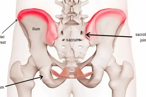 Anatomia del bacino con evidenziata la cresta iliaca. Il dolore alla cresta iliaca può avere vari sintomi.