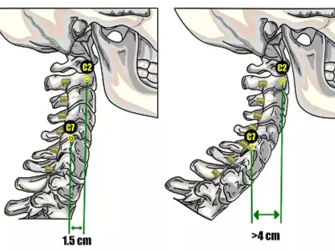 Iperlordosi cervicale, cosa significa e come gestirla