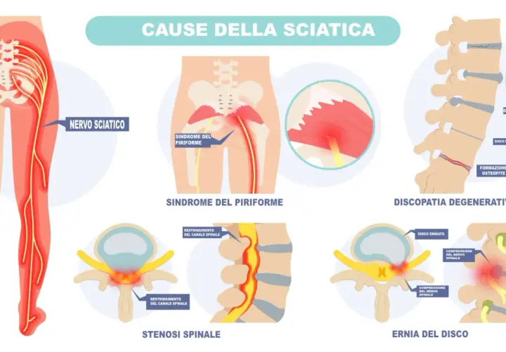 Illustrazione delle cause della sciatica: nervo sciatico, sindrome del piriforme, discopatia degenerativa, stenosi spinale ed ernia del disco. Addio al dolore del nervo sciatico.