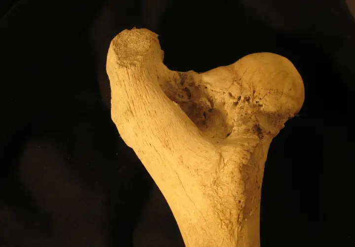 Frammento osseo con segni di necrosi testa femore. La terapia farmacologica è fondamentale per contrastare questa condizione.