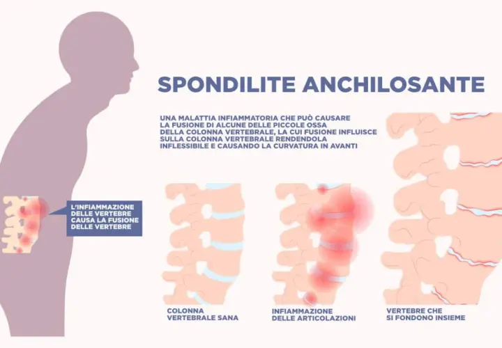 Illustrazione della spondilite anchilosante: infiammazione vertebrale che causa fusione, rigidità e curvatura. La durata vita non è influenzata significativamente.