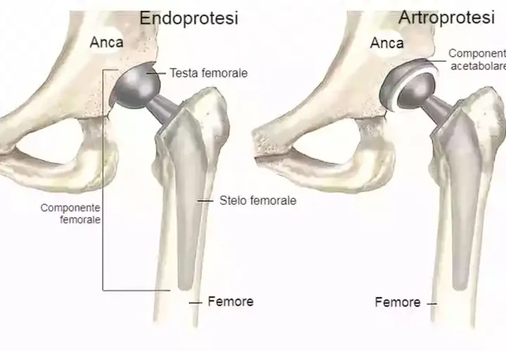 Illustrazione comparativa di protesi d'anca: endoprotesi e artroprotesi. La protesi totale d'anca sostituisce l'articolazione danneggiata.