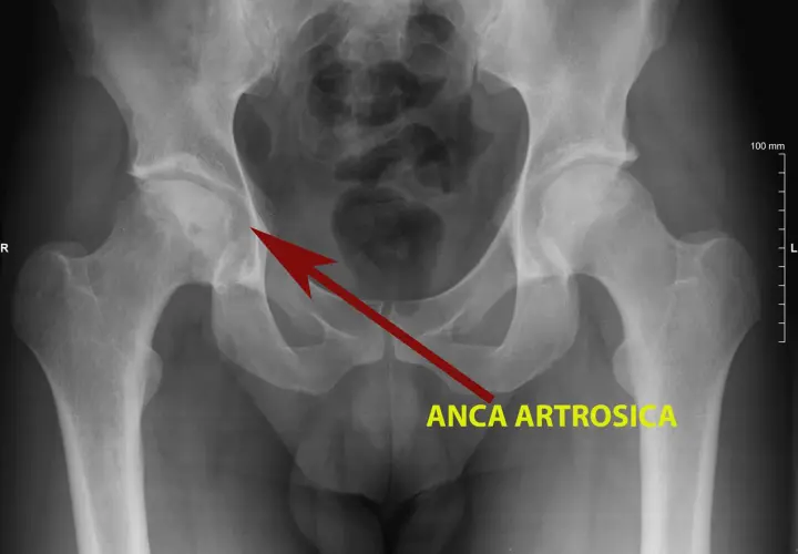 Radiografia del bacino che mostra un'anca artrosica, con freccia rossa che indica l'area interessata, suggerendo possibili coxalgia sintomi.