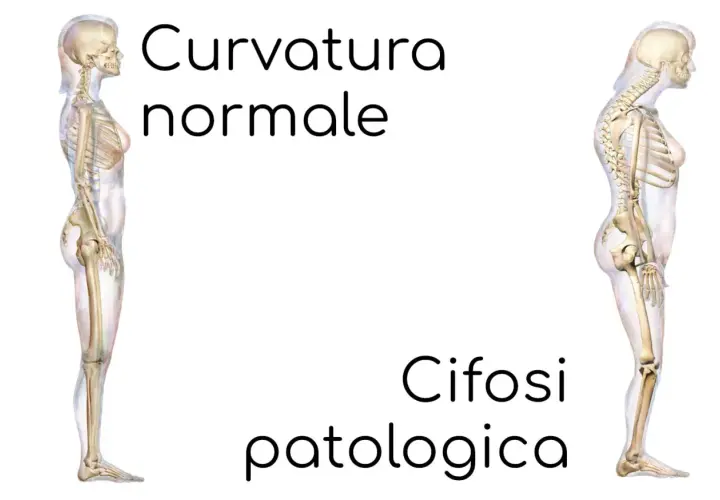 Confronto tra colonna vertebrale con curvatura normale e cifosi patologica. Si guarisce dalla cifosi?