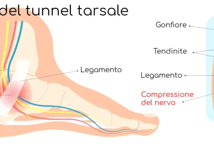 Illustrazione anatomica del tunnel tarsale: nervo tibiale posteriore compresso, gonfiore e tendinite.